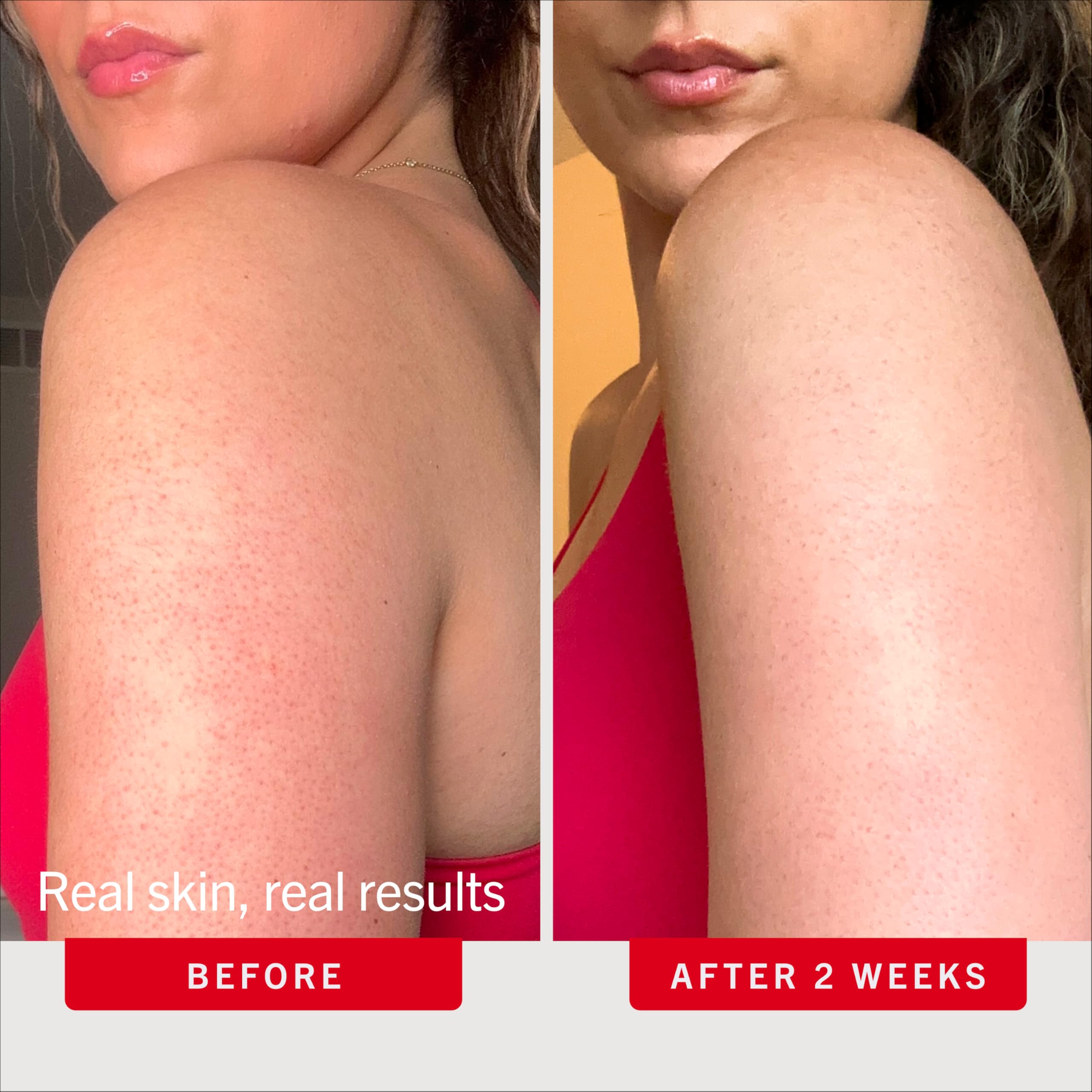 First Aid Beauty KP Bump Eraser Body Scrub with 10% AHA - Dermatologist-Tested Keratosis Pilaris Exfoliator - Support for Rough Bumps, Uneven Skin Texture & Strawberry Skin - Sensitive Skin detail image 4